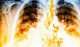 Το ηλεκτρονικό τσιγάρο συνδέεται με την πνευμονία- Τι βρήκαν οι επιστήμονες!!!,