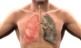 Σε πόσο καιρό θα καθαρίσουν οι πνεύμονες,αν κόψετε σήμερα το κάπνισμα