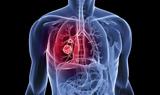 Νέα δεδομένα αλλάζουν το «τοπίο» στην αντιμετώπιση του καρκίνου του πνεύμονα,