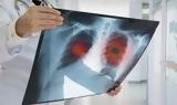 Νέα δεδομένα αλλάζουν το «τοπίο» στην αντιμετώπιση του καρκίνου του πνεύμονα!!!,