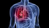 Νέα δεδομένα για τη θεραπεία του καρκίνου του πνεύμονα,