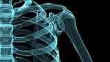 Τι είναι το οστεοσάρκωμα και τι επιπτώσεις έχει στα οστά;,