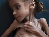 Ωραίο, Πέθανε, 7χρονη Αμάλ, Υεμένη,oraio, pethane, 7chroni amal, yemeni