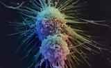 Ένας ιός φαίνεται να ενοχοποιείται για οκτώ στους δέκα καρκίνους του πρωκτού,