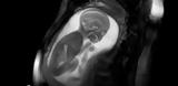 Η υγεία του εμβρύου σε 3D: Η μέθοδος ενάντια στις καρδιακές παθήσεις είναι εδώ (vid),