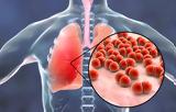 Τι είναι η πνευμονιοκοκκική νόσος και πόσο απειλεί την υγεία μας,