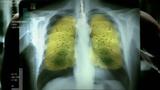 Καρκίνος Πνεύμονα,karkinos pnevmona