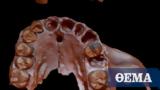 Στα δόντια ενός... κανίβαλου προγόνου μας βρέθηκε το αρχαιότερο ανθρώπινο γενετικό υλικό,
