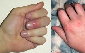 10 σημάδια στα χέρια που φανερώνουν σοβαρότερες παθήσεις και γιατί δεν πρέπει να τα αγνοήσετε