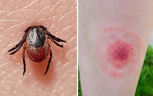 Βορρελίωση, Lyme, vorreliosi, Lyme