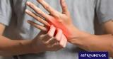 Ψωρίαση,psoriasi