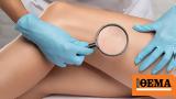 Πότε, Ενδοαυλικό Laser,pote, endoavliko Laser