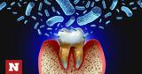 Περιοδοντίτιδα, Πώς,periodontitida, pos