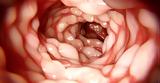 Νόσος Crohn,nosos Crohn