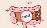 Νέα ανακάλυψη για τον καρκίνο του εντέρου προσφέρει ελπίδες για θεραπεία,
