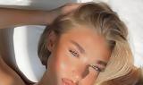 Lip Fillers,