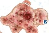 Προβληματισμός, Ινδία, Νεκρά, Naegleria,provlimatismos, india, nekra, Naegleria