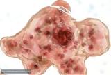 Ινδία, Νεκρά, Naegleria,india, nekra, Naegleria