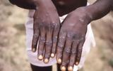 Ιός Mpox, – Ποιοι,ios Mpox, – poioi