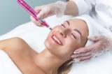 Microneedling,