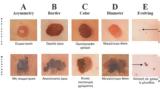 Μελάνωμα, Ποιος, D Πώς,melanoma, poios, D pos