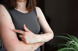 Mpox, Ραγδαία, Αφρική –, ECDC,Mpox, ragdaia, afriki –, ECDC