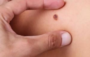 Μελάνωμα, melanoma